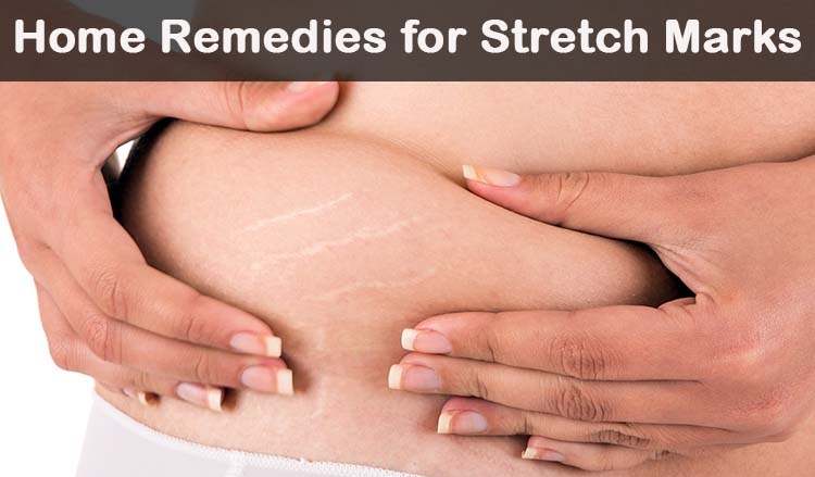 Natural Home-Made Remedies for Stretch Marks